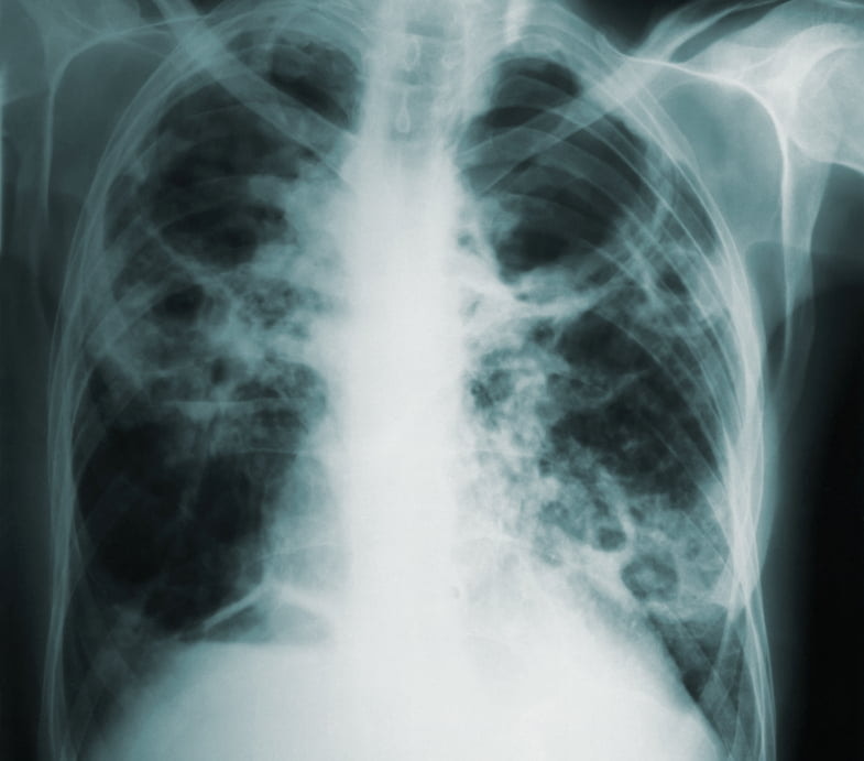 Plate showing lung damage caused by smoking