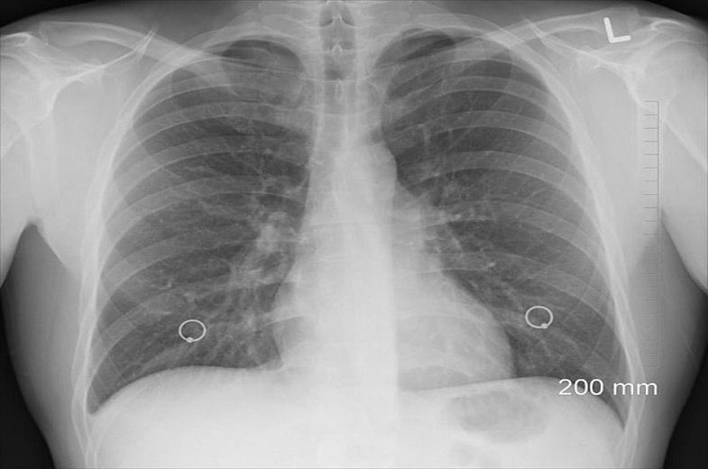 Electronic cigarette diacetyl and popcorn lung